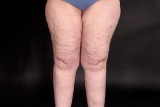 lipoedema