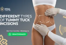 Different types of tummy tuck incisions – Complete Guide