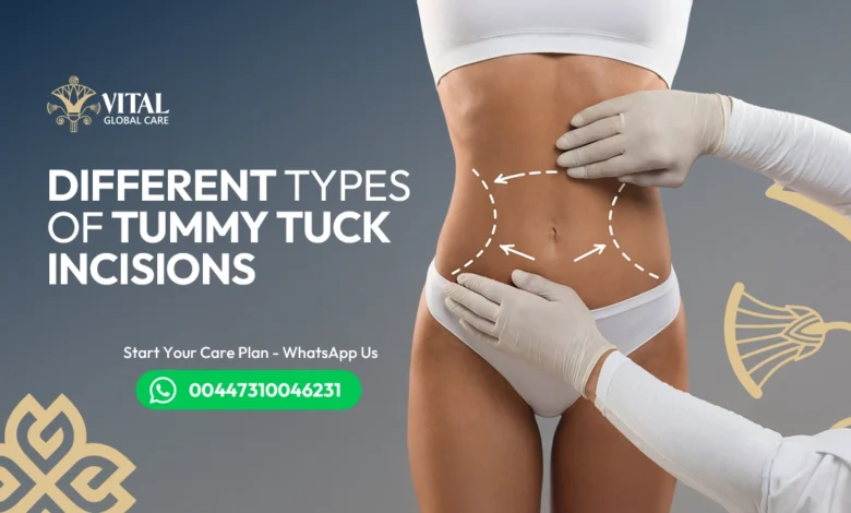 Different types of tummy tuck incisions – Complete Guide