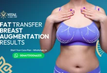 Fat Transfer Breast Augmentation Results - 5-Year Lift