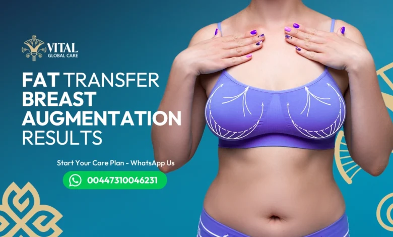 Fat Transfer Breast Augmentation Results - 5-Year Lift