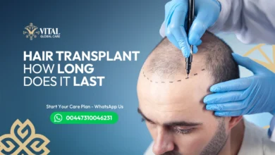 Hair Transplant How Long Does It Last? Lifetime Results?
