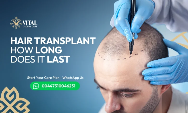 Hair Transplant How Long Does It Last? Lifetime Results?