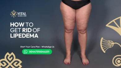 How to Get Rid of Lipoedema – Consult UK Specialists Today