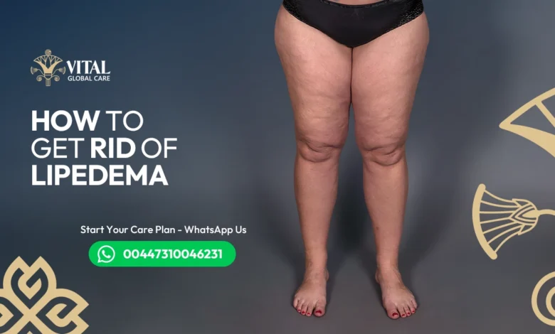How to Get Rid of Lipoedema – Consult UK Specialists Today
