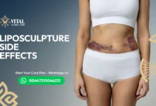 Liposculpture Side Effects UK - What to Expect After Surgery
