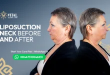 Liposuction Neck Before and After Say Goodbye to Double Chin