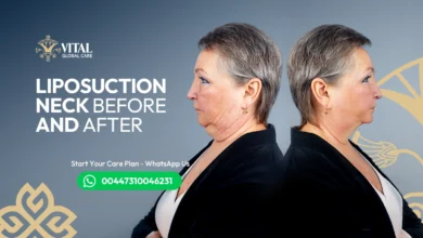 Liposuction Neck Before and After Say Goodbye to Double Chin