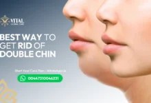 Best Way to Get Rid of Double Chin - Doctor-Approved Methods
