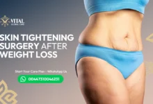 Skin Tightening Surgery After Weight Loss - The Guide