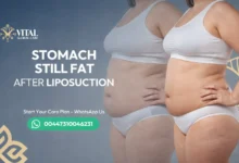 Stomach Still Fat After Liposuction - Results Timeline