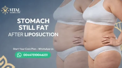 Stomach Still Fat After Liposuction - Results Timeline