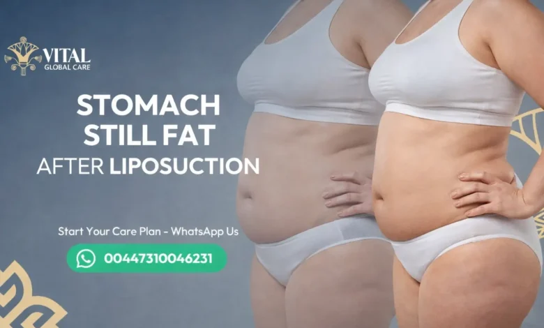 Stomach Still Fat After Liposuction - Results Timeline
