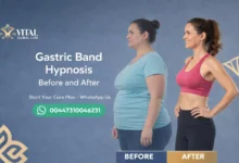 Does it Work Gastric Band Hypnosis Before and After Reveal