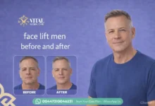 Top Face Lift Men Before and After Transformations Guide