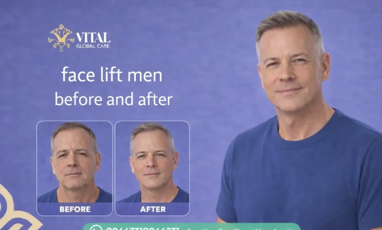 Top Face Lift Men Before and After Transformations Guide